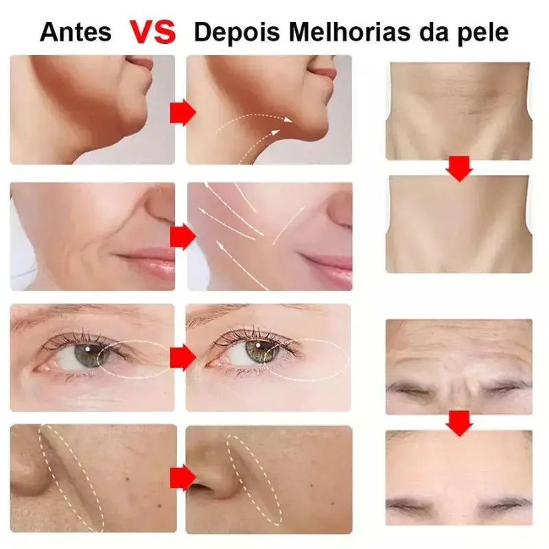 Ultrassom Facial Microfocado
